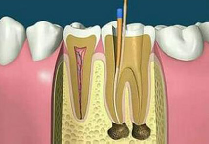 根管治疗