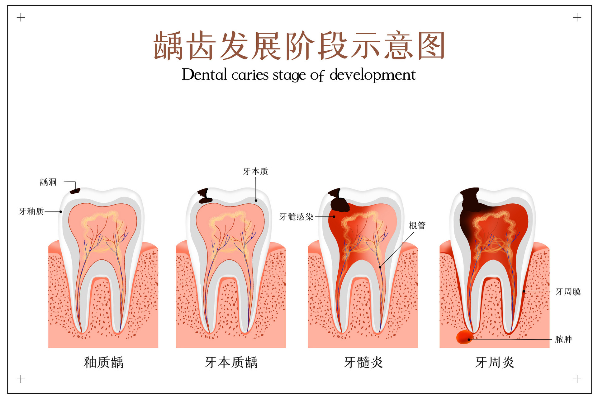 牙齿龋坏进程.jpg
