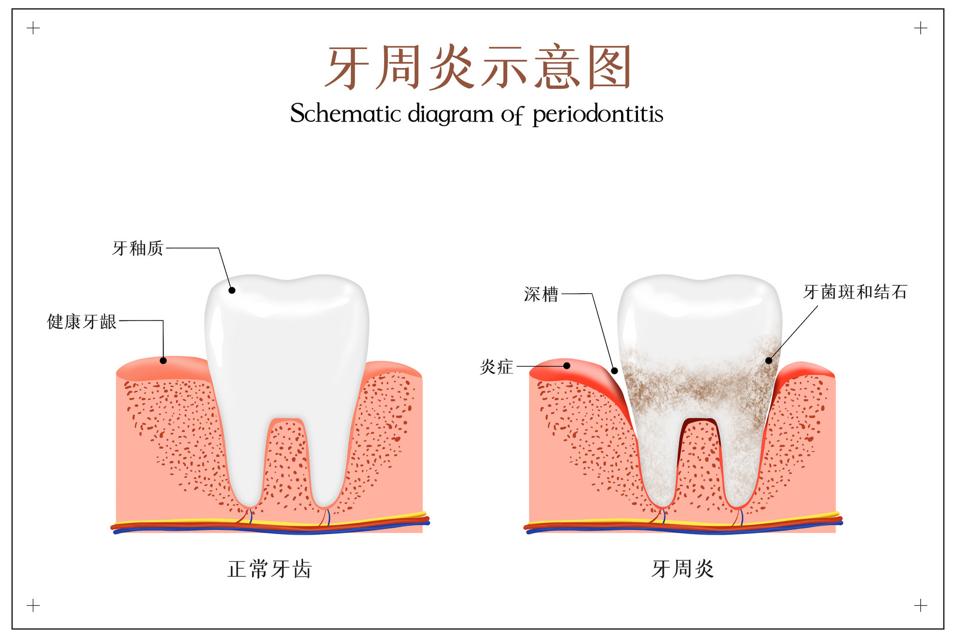 摄图网_401803633_banner_牙周炎示意图（非企业商用）.jpg